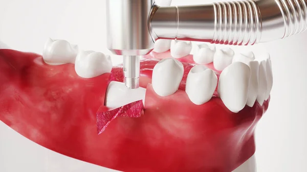 Imagen de implantación dental serie 5 de 13 - 3D Rendering — Foto de Stock