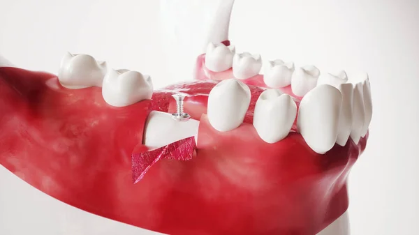Implantação de dentes série de imagens 7 de 13 - 3D Rendering — Fotografia de Stock