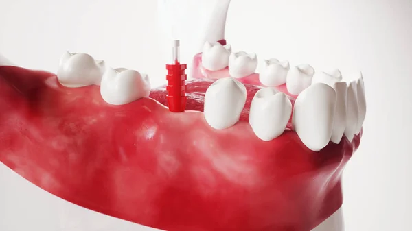 Зубная имплантация серия 91 из 13 - 3D рендеринг — стоковое фото