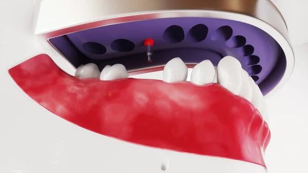 Imagen de implantación dental serie 10 de 13 - 3D Rendering — Foto de Stock
