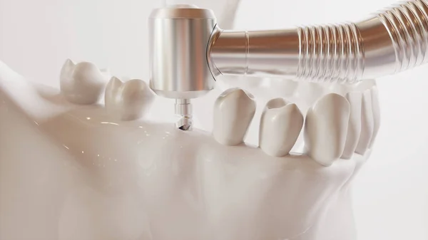 Zdjęcie implantacji zębów serii V02 - 2 z 8 - 3d Rendering — Zdjęcie stockowe