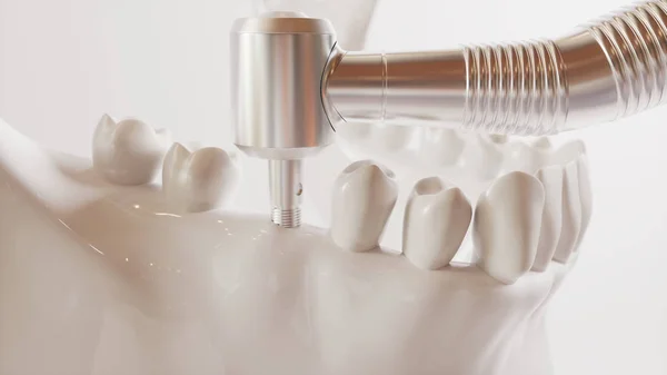 Implantação de dentes série de imagens V02 - 3 de 8 - 3D Rendering — Fotografia de Stock