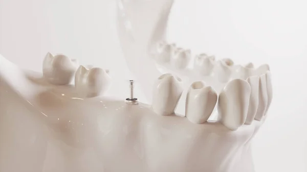 Imagen de implante dental serie V02 - 4 de 8 - Representación 3D — Foto de Stock