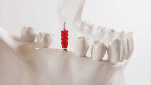 Imagen de implante dental serie V02 - 5 de 8 - Representación 3D — Foto de Stock