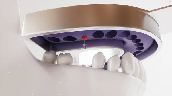 Imagen de implante dental serie V02 - 6 de 8 - Representación 3D — Foto de Stock
