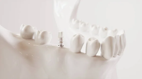 Imagen de implante dental serie V02 - 7 de 8 - Representación 3D — Foto de Stock
