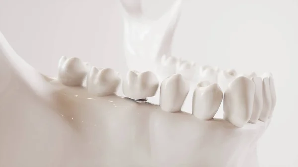 歯の注入画像シリーズV02 - 8の8 - 3Dレンダリング — ストック写真