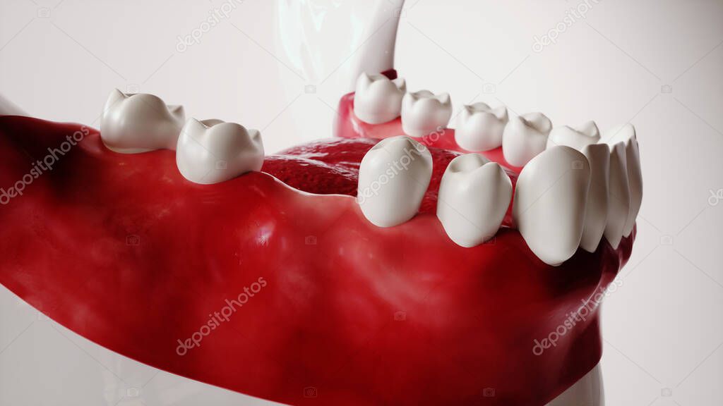 Tooth implantation picture series 1 of 13 - 3D Rendering