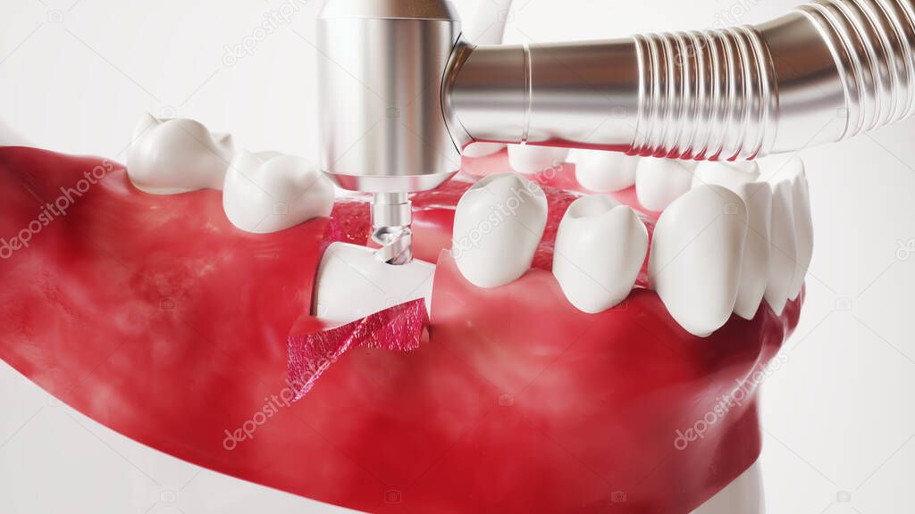Tooth implantation picture series 4 of 13 - 3D Rendering