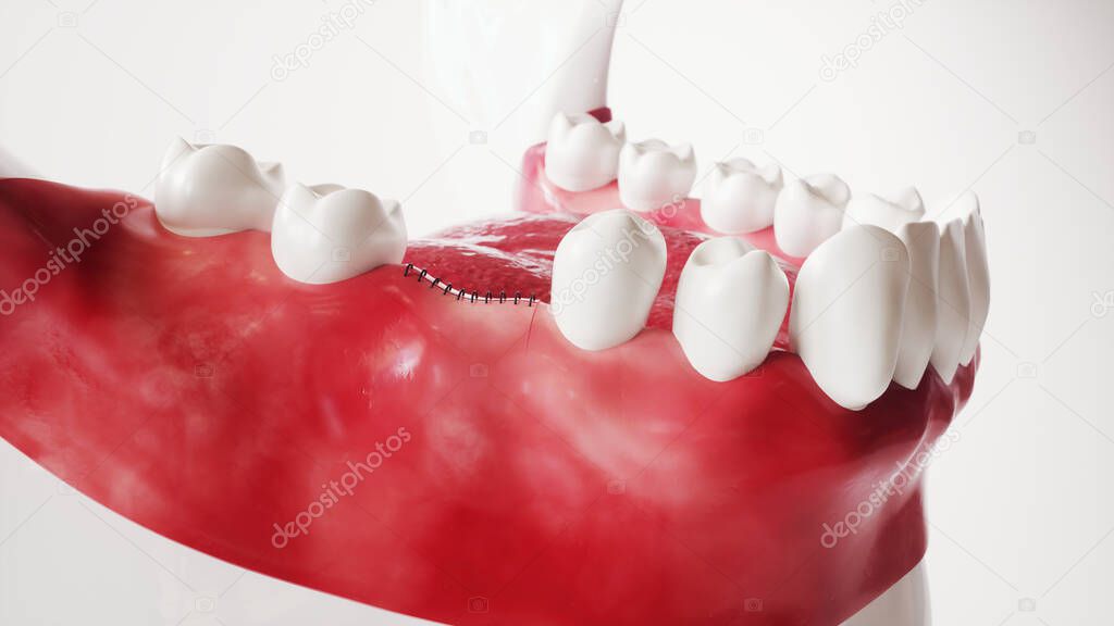 Tooth implantation picture series 8 of 13 - 3D Rendering