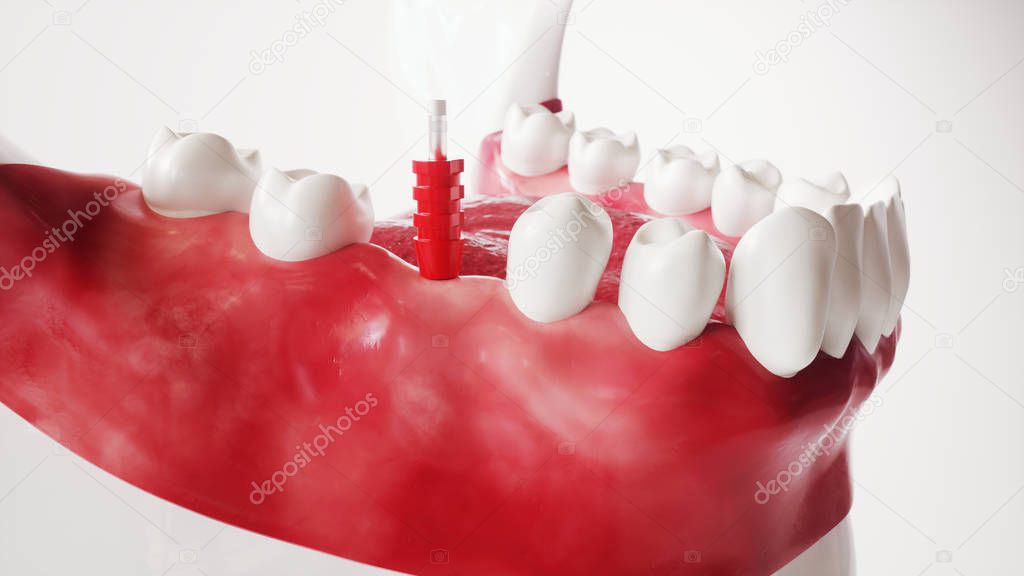 Tooth implantation picture series 91 of 13 - 3D Rendering