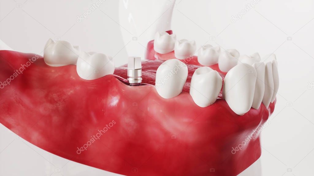 Tooth implantation picture series 11 of 13 - 3D Rendering