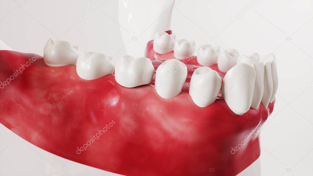 Tooth implantation picture series 13 of 13 - 3D Rendering