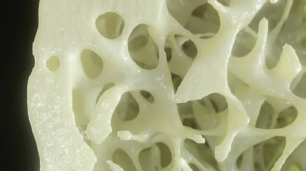Bone affected with osteoporosis - cross section - 3D rendering — Stock Photo, Image