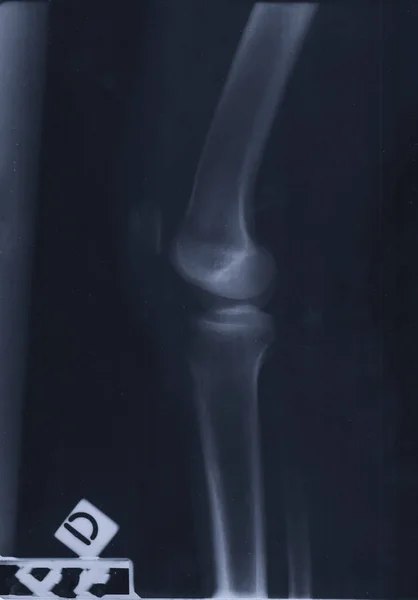 Detail of the X-ray of the bones of the human right knee — Stock Photo, Image
