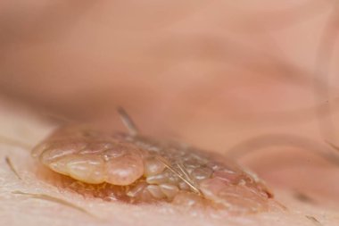 Deri siğili makro fotoğrafı, papilloma virüsü enfeksiyonu.