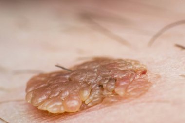 Deri siğili makro fotoğrafı, papilloma virüsü enfeksiyonu.