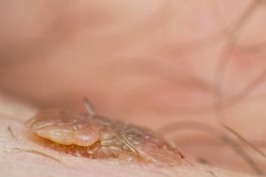 Deri siğili makro fotoğrafı, papilloma virüsü enfeksiyonu.