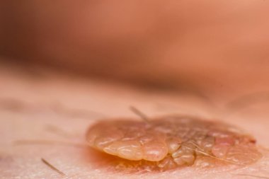 Deri siğili makro fotoğrafı, papilloma virüsü enfeksiyonu.