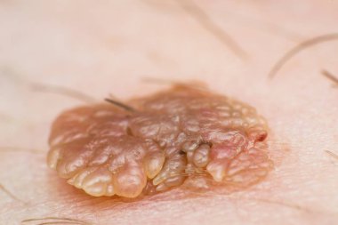 Deri siğili makro fotoğrafı, papilloma virüsü enfeksiyonu.