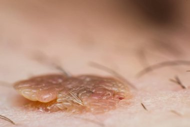Deri siğili makro fotoğrafı, papilloma virüsü enfeksiyonu.