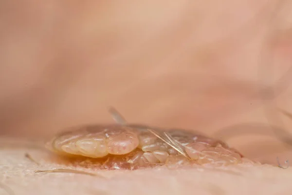 Makrofoto av en hudvårta, papillom virusinfektion — Stockfoto