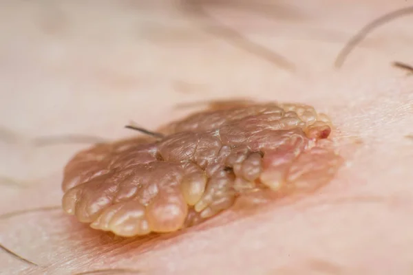 Macro foto de uma verruga de pele, infecção pelo vírus do papiloma — Fotografia de Stock