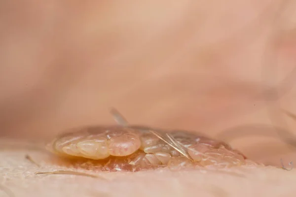Macro photo of a skin wart, papilloma virus infection — Stock Image Macro photo of a skin wart, papilloma virus infection Stock Image