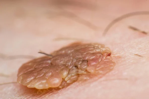 papiloame pe scalp