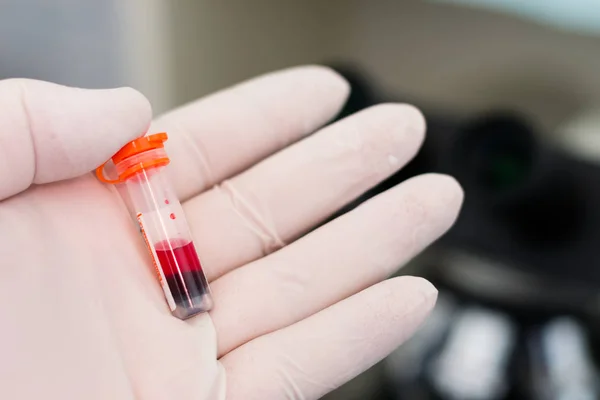 Hæmolyseret blodprøve i hånden af videnskabsmand - Stock-foto