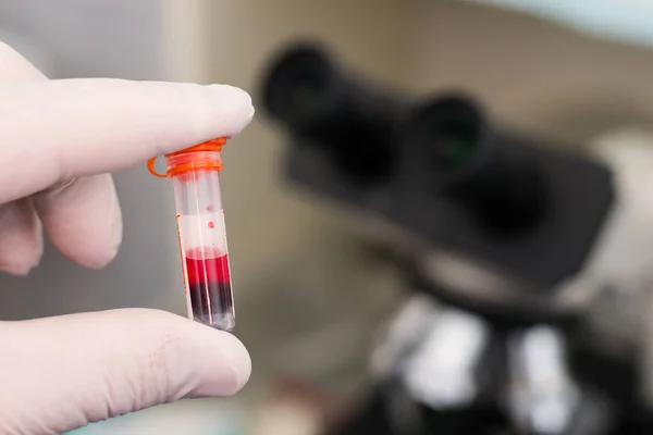 Hæmolyseret blodprøve i hånden af videnskabsmand - Stock-foto