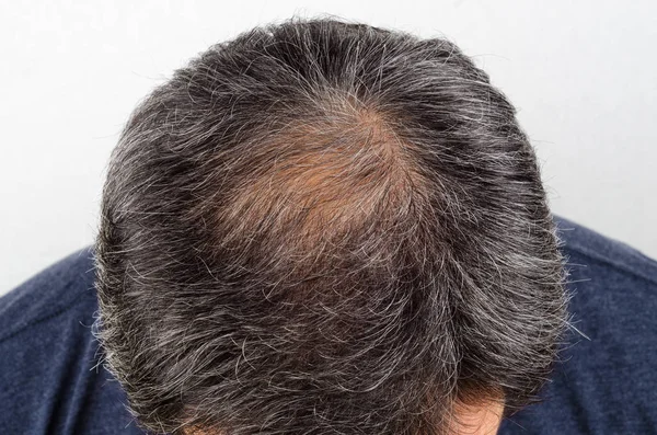 man with hair loss and grey hair.