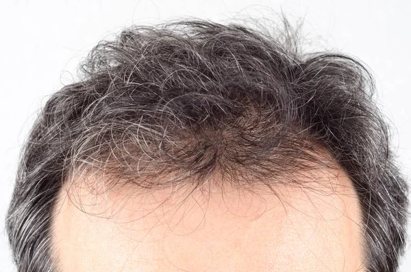 Uomo problema di perdita dei capelli . — Foto Stock