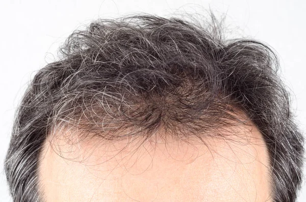 Hombre pérdida de cabello problema . — Foto de Stock