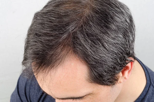 Hombre pérdida de cabello problema — Foto de Stock