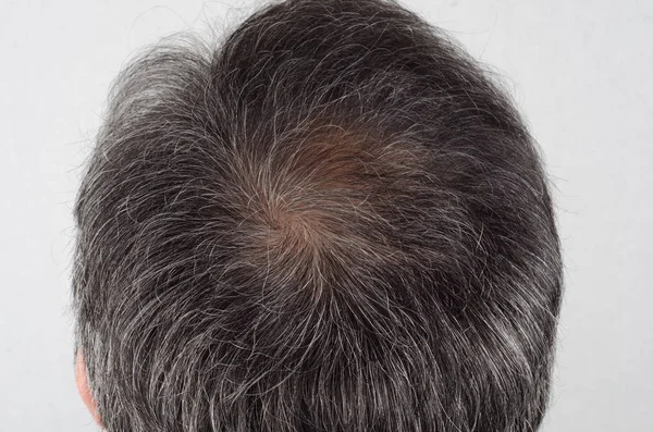 man with hair loss and grey hair.