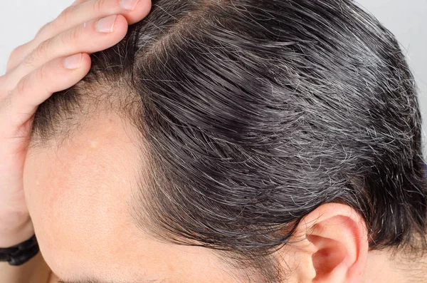 Man hair loss problem — Stock Photo, Image