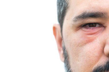 Metin için kopyalama alanı olan gözlerinde stye olan adam