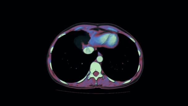 RM a contrasto della cavità addominale, tratto gastrointestinale, vescica — Video Stock