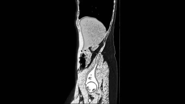 RM de contraste da cavidade abdominal, trato gastrointestinal, bexiga — Vídeo de Stock