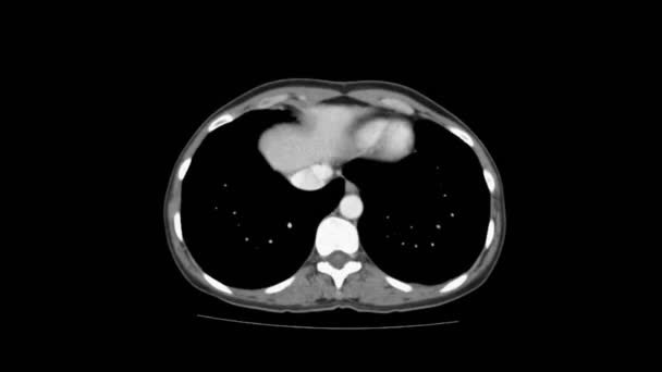 RM de contraste da cavidade abdominal, trato gastrointestinal, bexiga — Vídeo de Stock