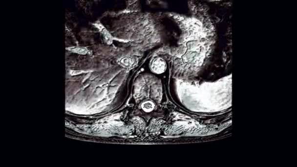 МРТ грудной клетки, обнаружение выступов и грыж на позвоночнике — стоковое видео