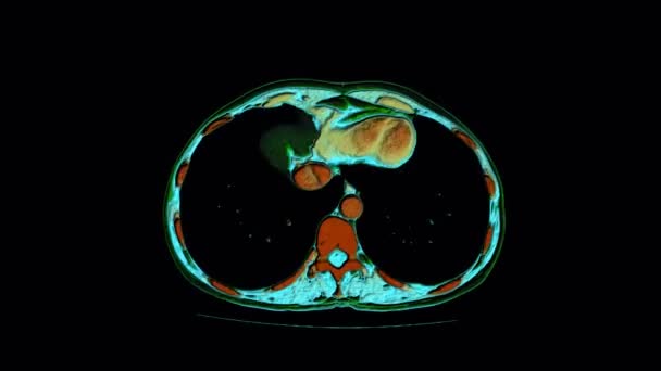 Contraste de cor RM da cavidade abdominal, trato gastrointestinal, bexiga — Vídeo de Stock