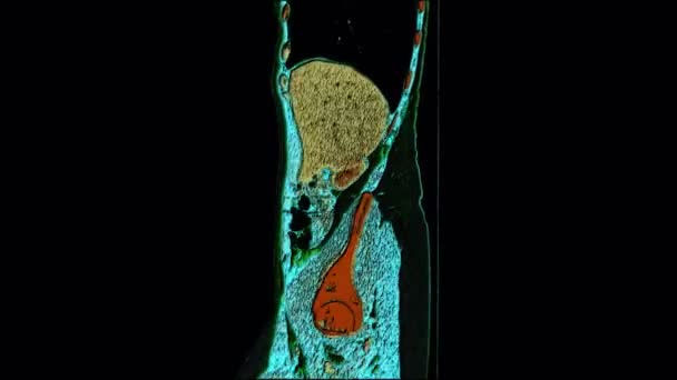 Färgkontrast Mri i bukhålan, mag-tarmkanalen, urinblåsan — Stockvideo