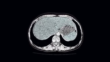 Karın boşluğukontrast MrG, gastrointestinal sistem, mesane