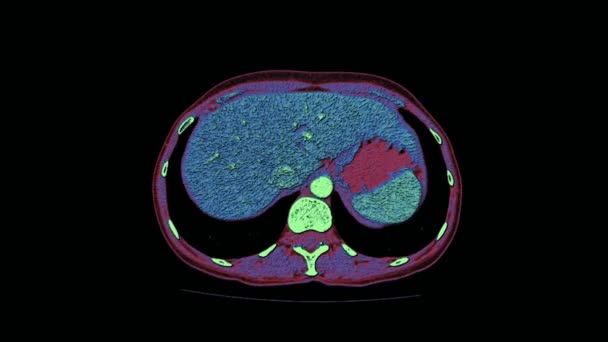 Кольорова контрастність МРТ черевної порожнини, шлунково-кишкового тракту, сечового міхура — стокове відео
