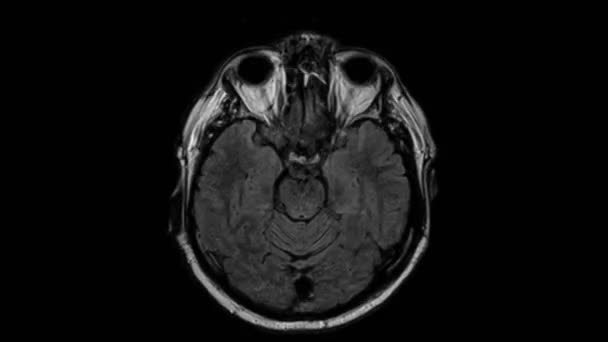 МРТ мозга, сканирование головы и обнаружение опухоли. Диагностический медицинский инструмент — стоковое видео