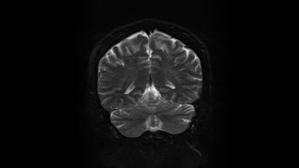 Brain Mri, skany głowy i wykrycie guza. Diagnostyczne narzędzie medyczne — Wideo stockowe