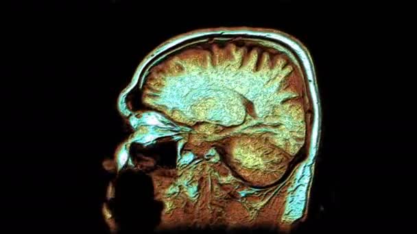 Massenhaft mehrfarbige MRI-Scans von Gehirn und Kopf, um Tumore zu erkennen. Diagnostisches medizinisches Werkzeug — Stockvideo