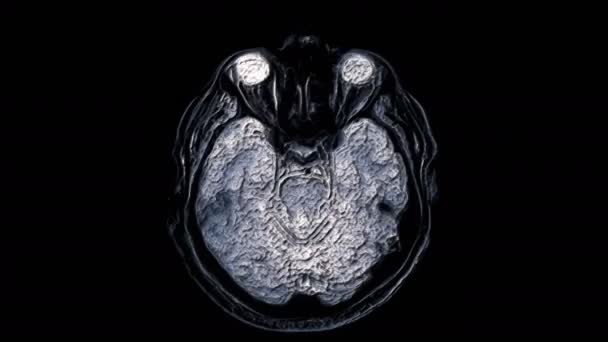 Έντονο χρώμα Mri σαρώνει τον εγκέφαλο και το κεφάλι για την ανίχνευση όγκων. Διαγνωστικό εργαλείο — Αρχείο Βίντεο